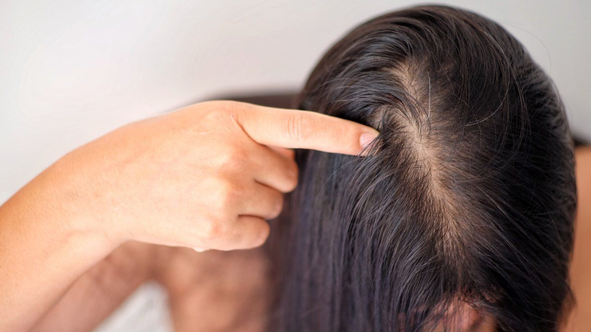 Actuar a tiempo la clave para frenar la caída del pelo en mujeres