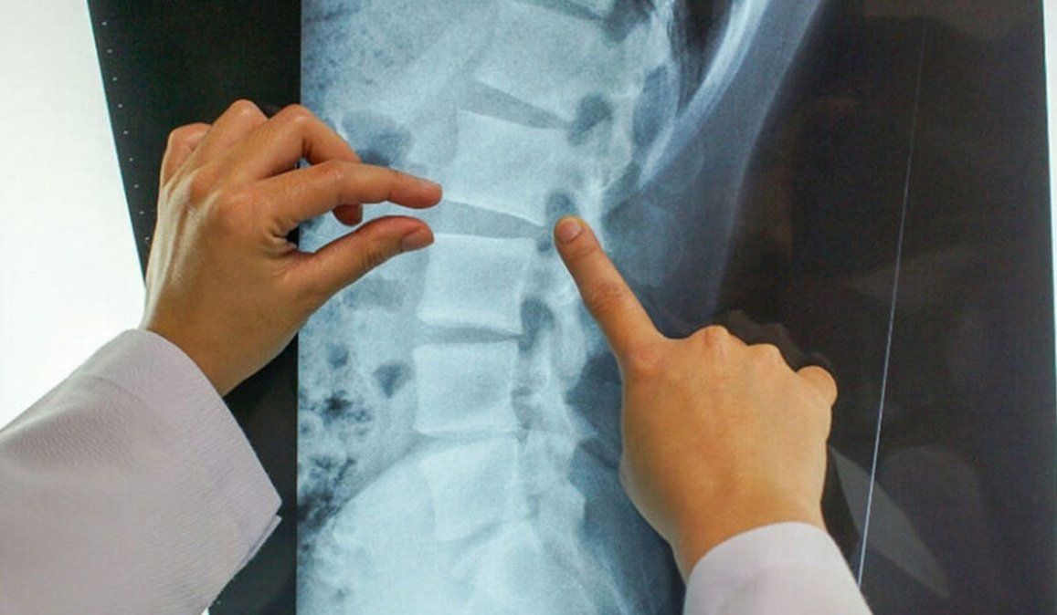 Síntomas de la mielitis transversa, que habría frenado la vacuna contra el coronavirus 