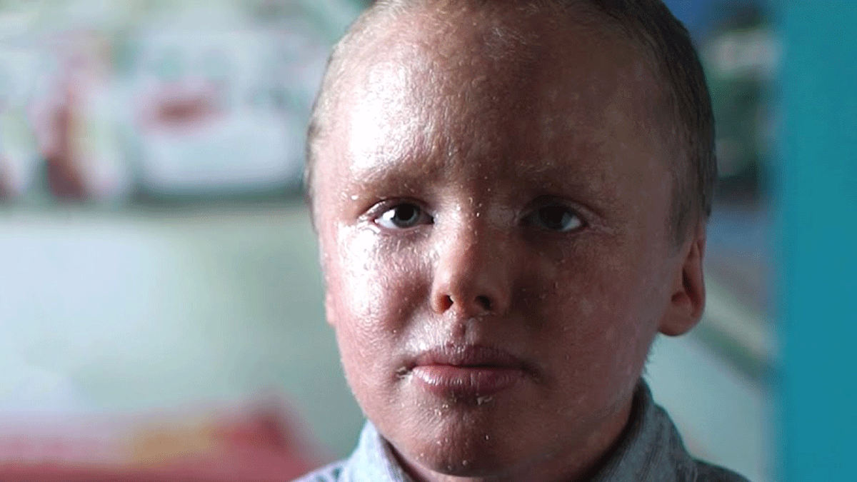 El niño tomate, el drama de un chico que padece una extraña enfermedad