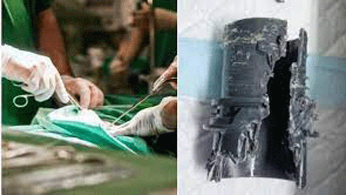 ¡Que hizo! Se quiso medir el pene con un caño y le quedó atascado.