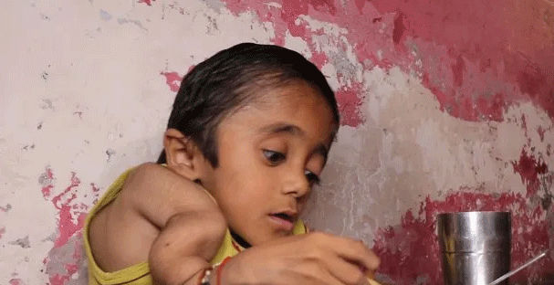 Dura enfermedad. La tremenda historia del "niño de vidrio": tiene 100 huesos rotos.