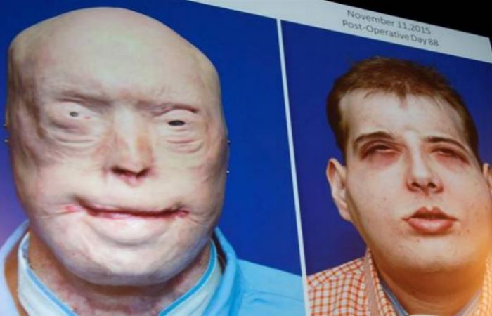 Antes y después. Progresión del rostro del paciente trasplantado en agosto.