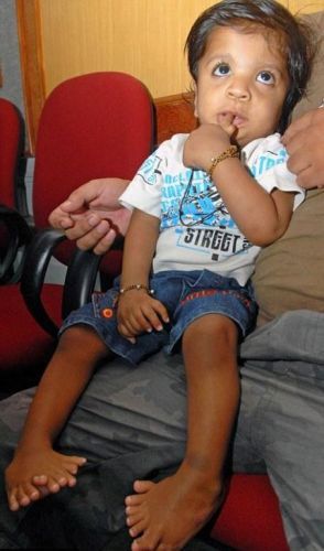 Nació en 2010 y fue operado en las últimas horas para extirparle falanges.