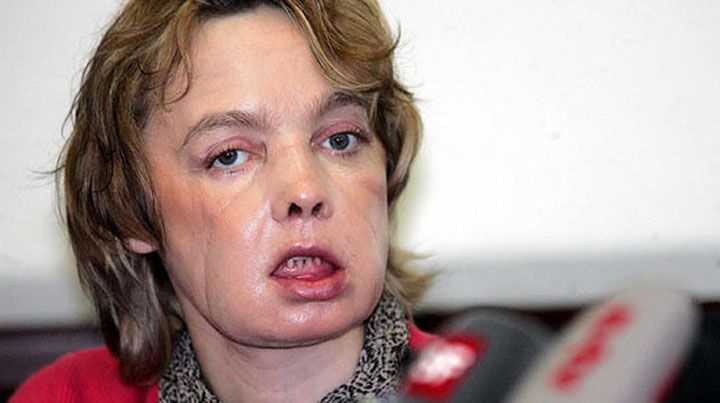 Isabelle Dinoire