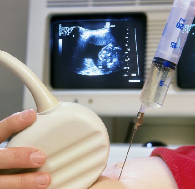 Estudios como la amniocentesis pueden detectar el síndrome de Down con exactitud, pero presentan riesgos para la salud del bebé por ser invasivos.