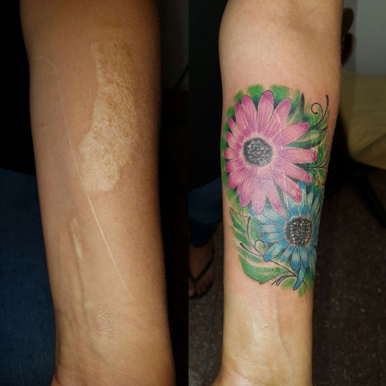 Su ex pareja le tiró agua hirviendo en el brazo.