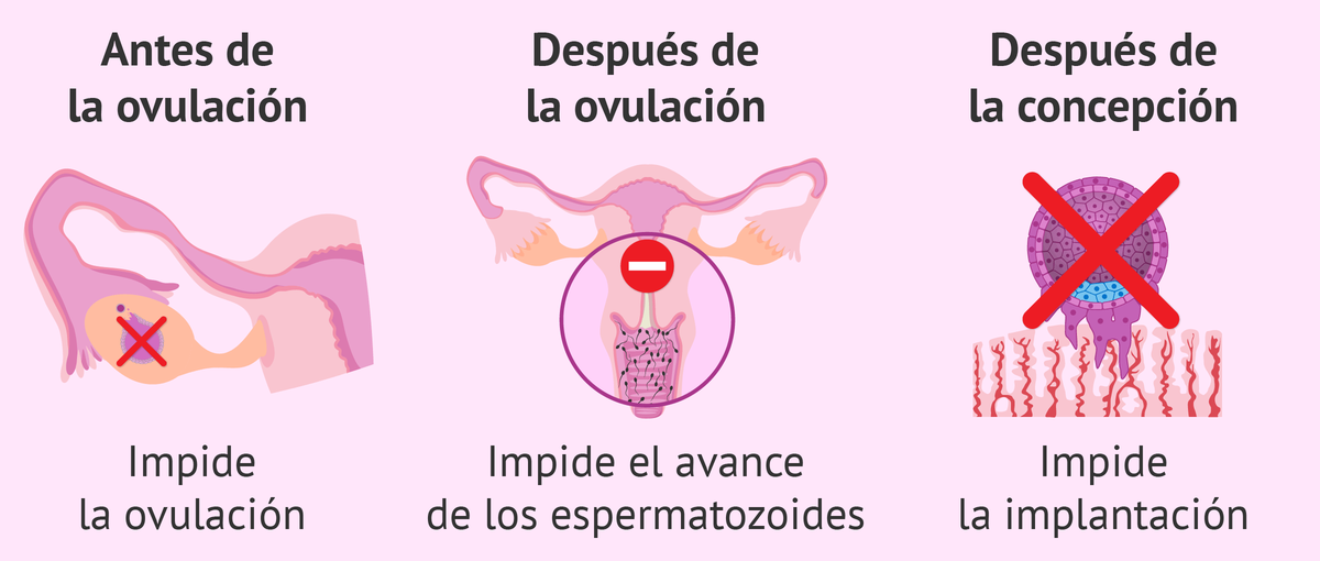 Cómo funciona la Pastilla del día después Cómo funciona la Pastilla del día después