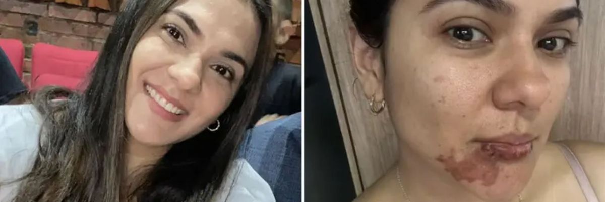 Empanada caliente. Una joven tuvo severas quemaduras en su rostro al comer una empanada hirviendo. Empanada caliente. Una joven tuvo severas quemaduras en su rostro al comer una empanada hirviendo. 