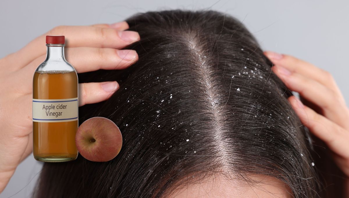 Paso a paso: cómo usar vinagre de manzana para combatir la caspa