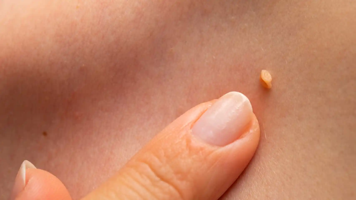 Trucos caseros: cómo eliminar las verrugas con 4 remedios naturales. Trucos caseros: cómo eliminar las verrugas con 4 remedios naturales.