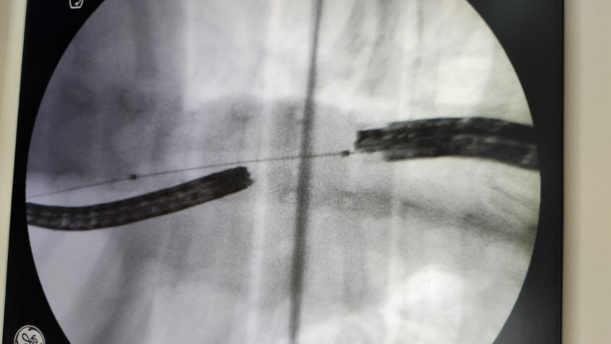 Momento en el que se pueden apreciar el encuentro de los dos endoscopios. El que ingresó por la boca y el que entra por el estómago. Momento en el que se pueden apreciar el encuentro de los dos endoscopios. El que ingresó por la boca y el que entra por el estómago.