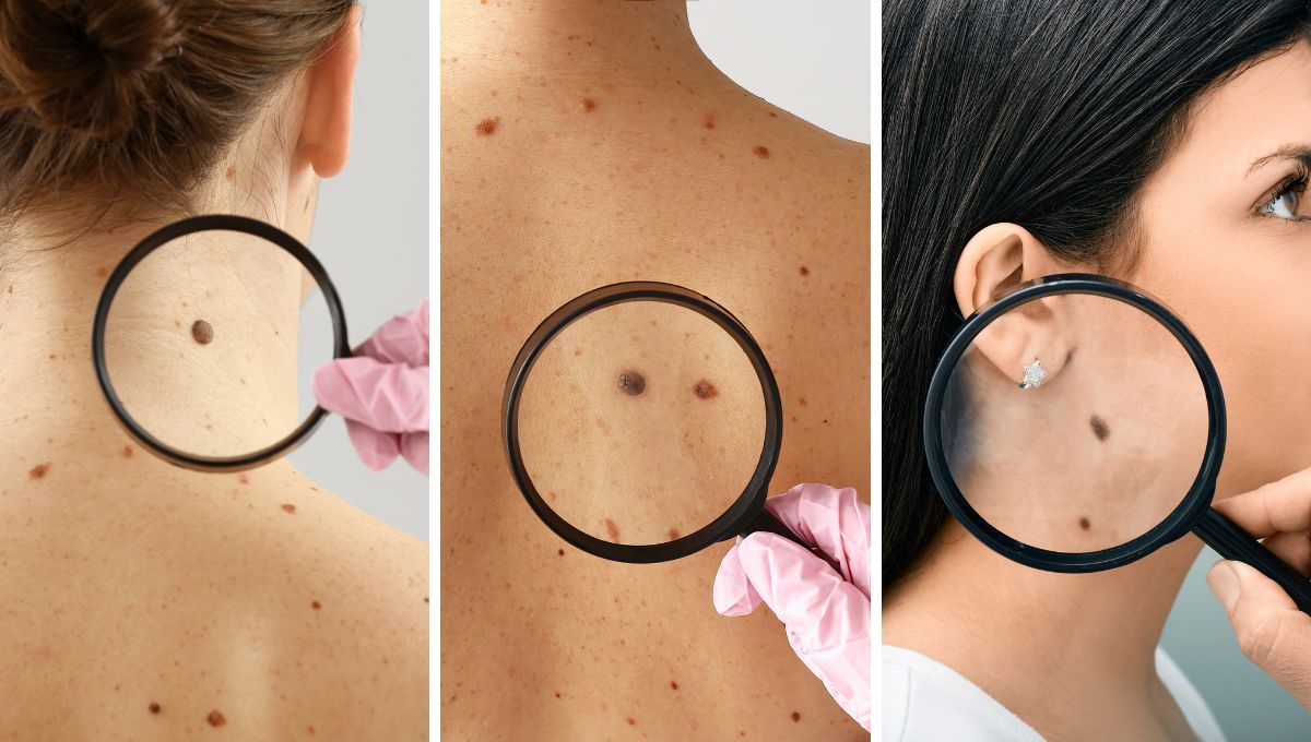 Descubre qué significado tienen los lunares según la zona del cuerpo donde se ubican