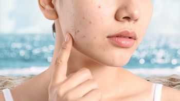 Por qué durante el verano nuestra piel se llena de más granitos Por qué durante el verano nuestra piel se llena de más granitos