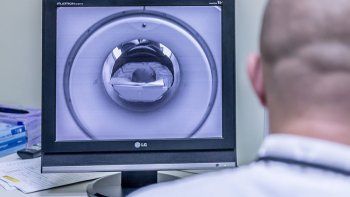 Hallaron 100 huevos de parásitos en el cerebro de una nena de 8 años