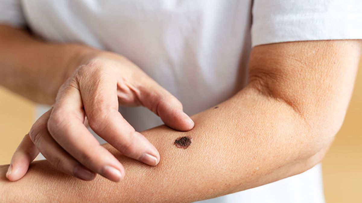 Día Mundial contra el Malenoma: advirtieron sobre el aumento de su incidencia en Latinoamérica