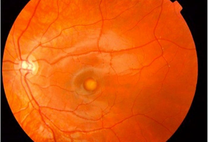 Una esperanza para los pacientes con distrofias de retina