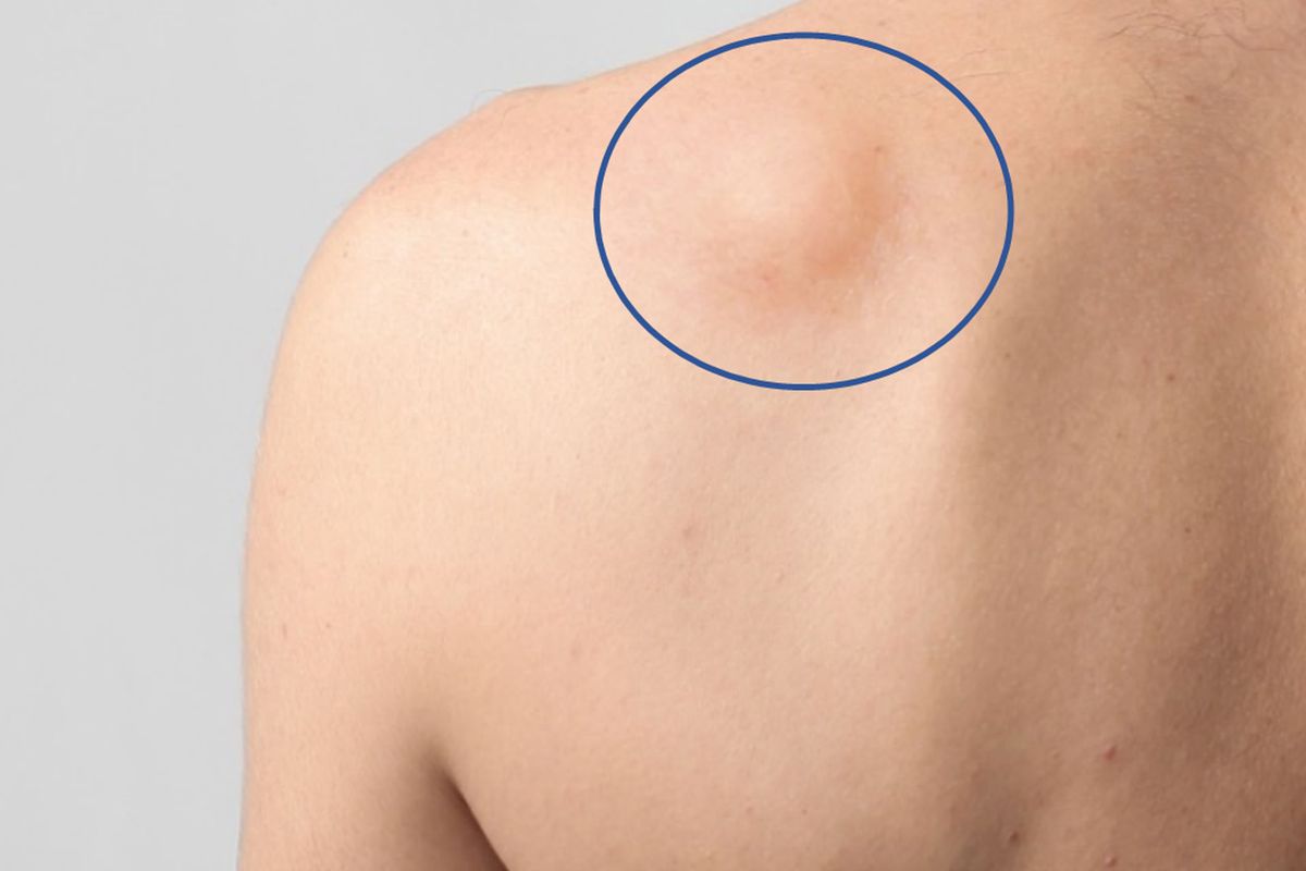 Lipomas en la piel: síntomas y causas según la medicina Lipomas en la piel: síntomas y causas según la medicina