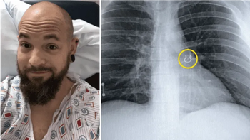 Creyó que tenía coronavirus pero le hallaron algo increíble en los pulmones