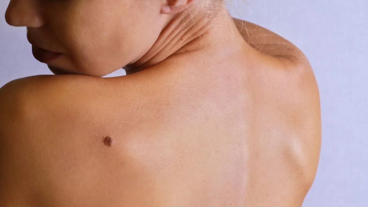 La aparición y engrosamiento de los lunares en la piel puede significar una síntoma de la enfermedad La aparición y engrosamiento de los lunares en la piel puede significar una síntoma de la enfermedad