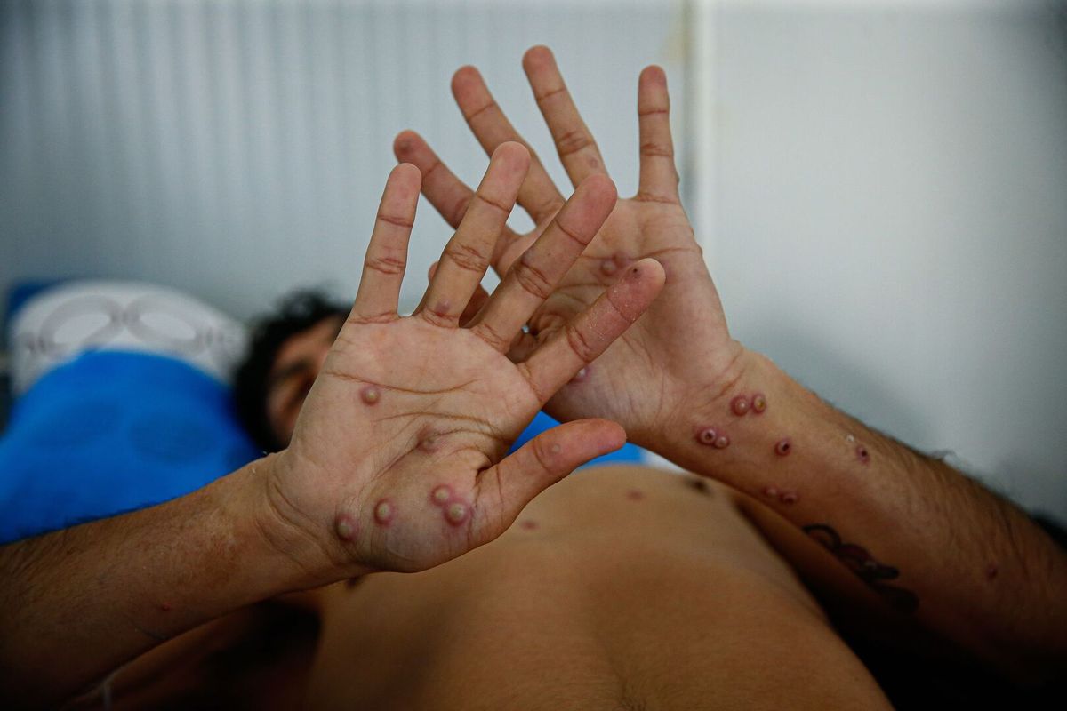 Viruela del mono: cuáles son los principales síntomas Viruela del mono: cuáles son los principales síntomas