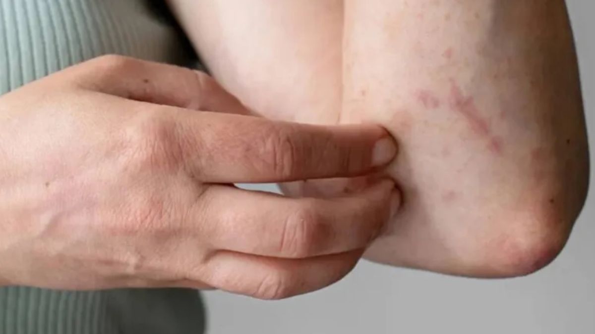 La picadura del mosquito que transmite la Encefalomielitis Equina es de color más rojozo y se forma como una roncha La picadura del mosquito que transmite la Encefalomielitis Equina es de color más rojozo y se forma como una roncha