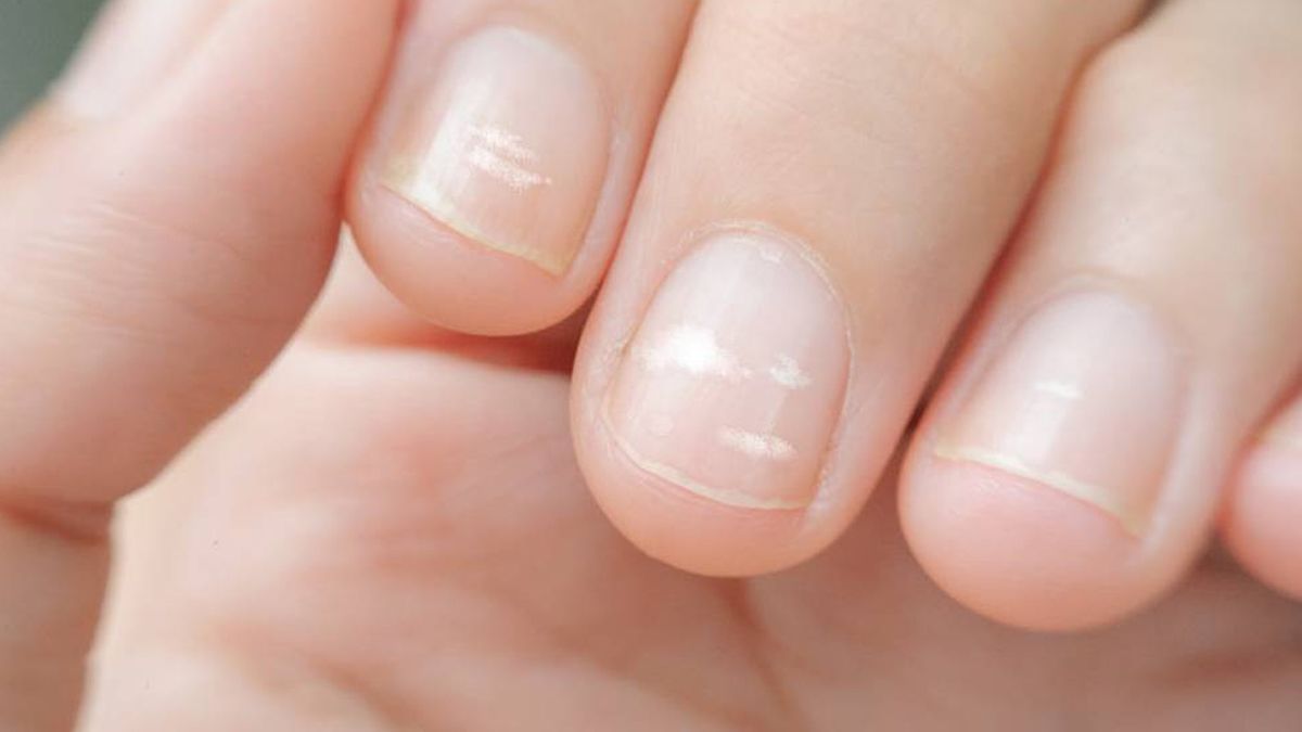 Las manchas blancas de las uñas no aparecen por falta de calcio. 