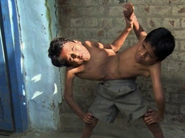 Increíble historia de estos hermanos siameses