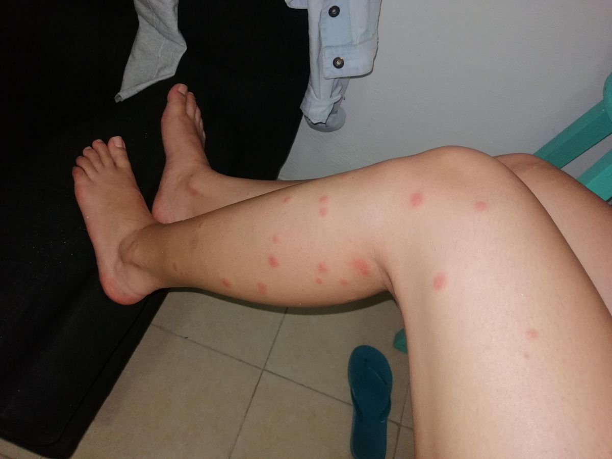 Una caminata por cualquier playa de Florida puede terminar con decenas de picaduras de mosquitos.