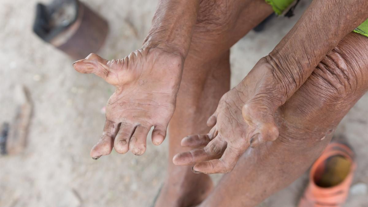 La lepra en Argentina tiene una "alta carga" con cerca de 150 nuevos casos por año y puede dejar graves secuelas La lepra en Argentina tiene una "alta carga" con cerca de 150 nuevos casos por año y puede dejar graves secuelas 