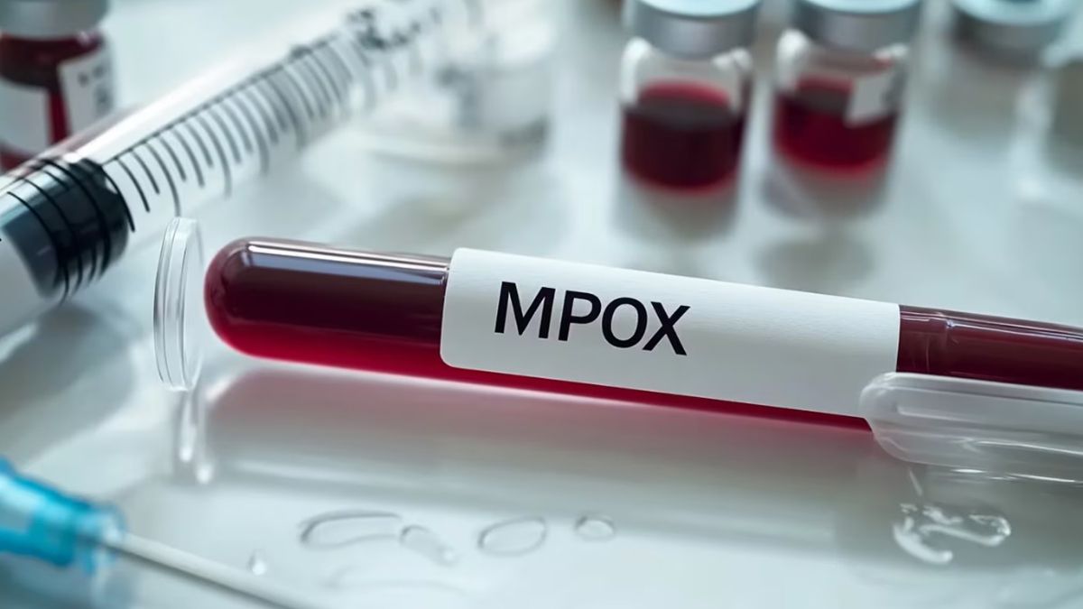 Se registraron 10 nuevos casos de viruela del mono en la Argentina y siete correspnden a la Ciudad de Buenos Aires Se registraron 10 nuevos casos de viruela del mono en la Argentina y siete correspnden a la Ciudad de Buenos Aires