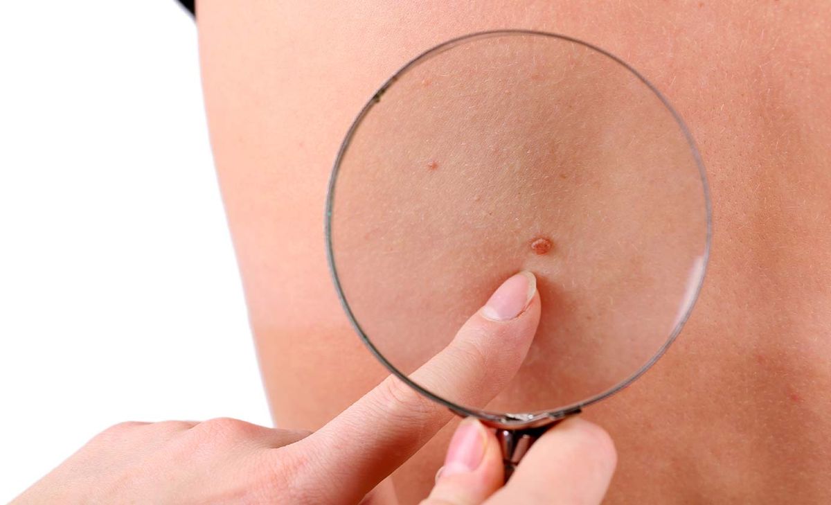 El sencillo y efectivo truco casero que es ideal para eliminar las verrugas pequeñas El sencillo y efectivo truco casero que es ideal para eliminar las verrugas pequeñas