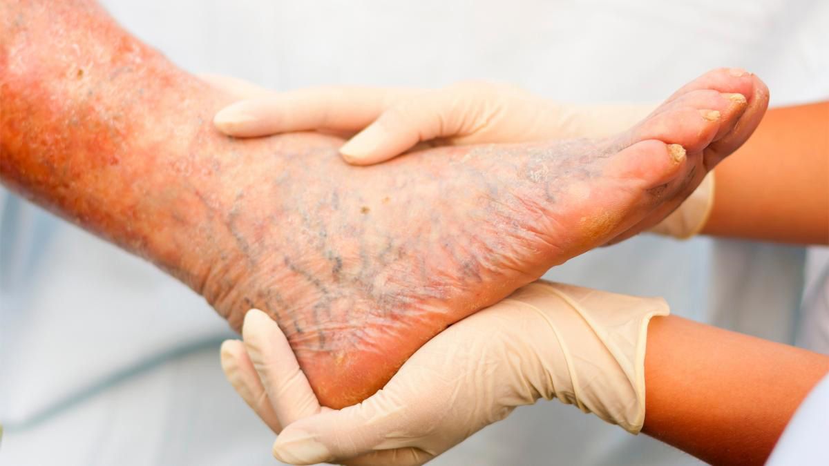 La lepra en Argentina tiene una "alta carga" con cerca de 150 nuevos casos por año y aconsejan consultas médicas ante una sospecha La lepra en Argentina tiene una "alta carga" con cerca de 150 nuevos casos por año y aconsejan consultas médicas ante una sospecha