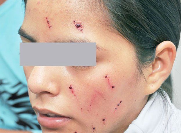 Un grupo de chicas raptó a otra y le cortó la cara con un bisturí