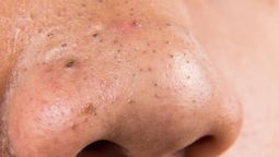 No todas las manchas negras de la nariz son puntos negros, según una dermatóloga: qué son