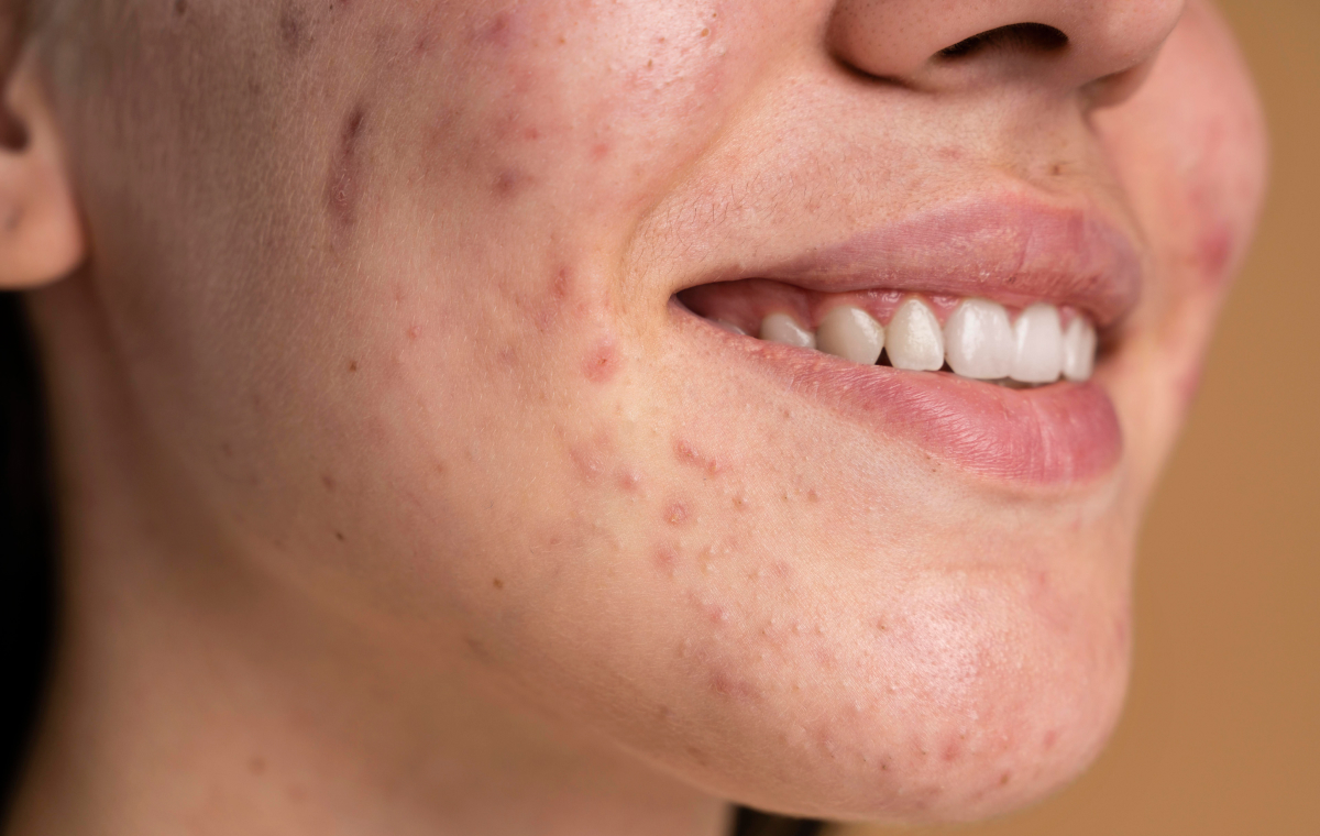 La mezcla en cuestión puede ser utilizada para eliminar el acné La mezcla en cuestión puede ser utilizada para eliminar el acné