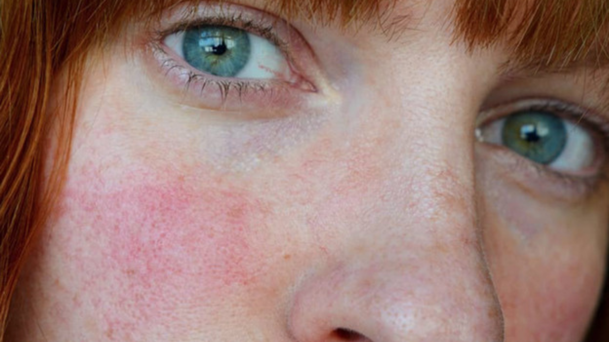 Con este truco podrás calmar el enrojecimiento de tus mejillas. Con este truco podrás calmar el enrojecimiento de tus mejillas.