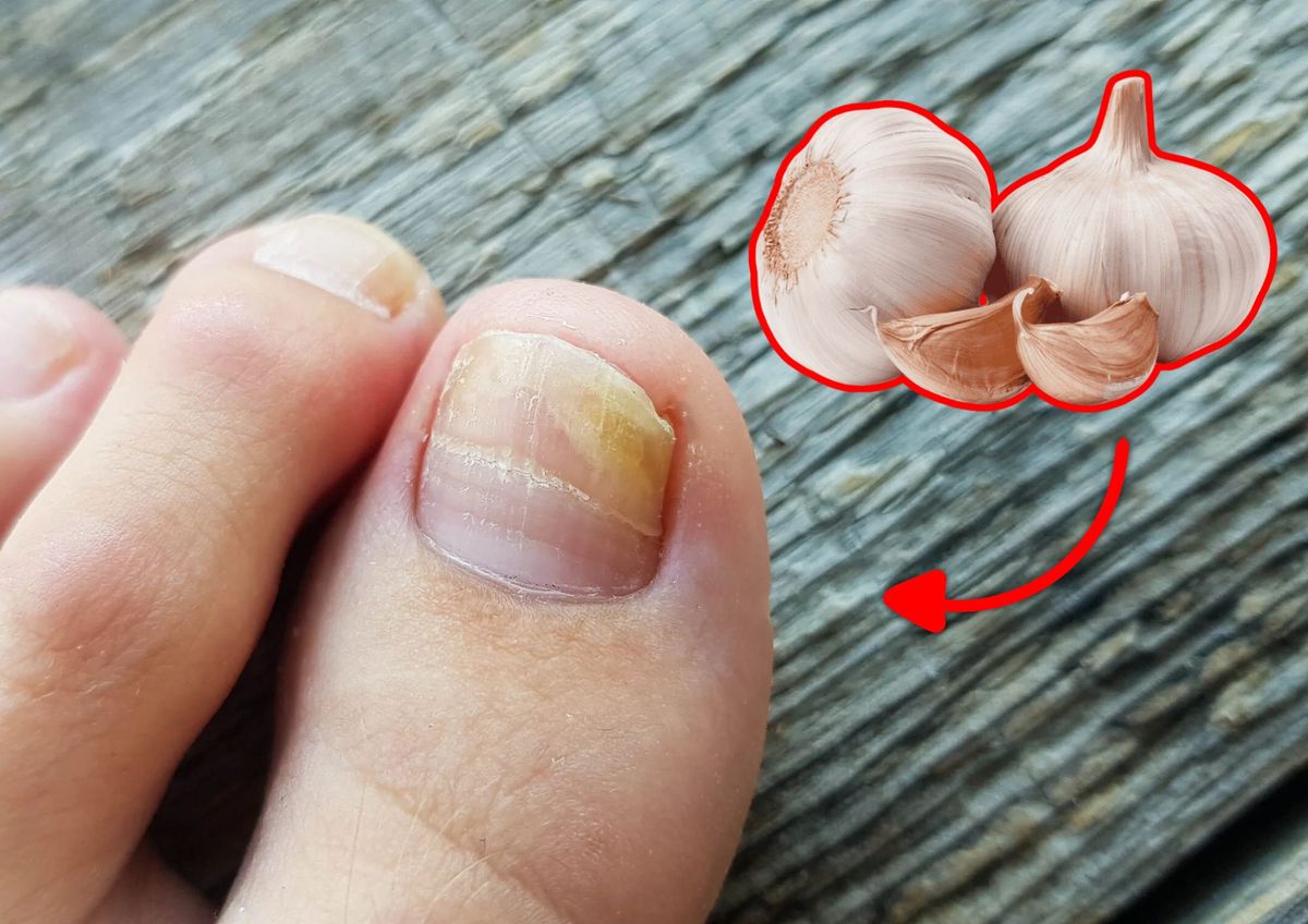 Los beneficios del ajo en las uñas&nbsp;