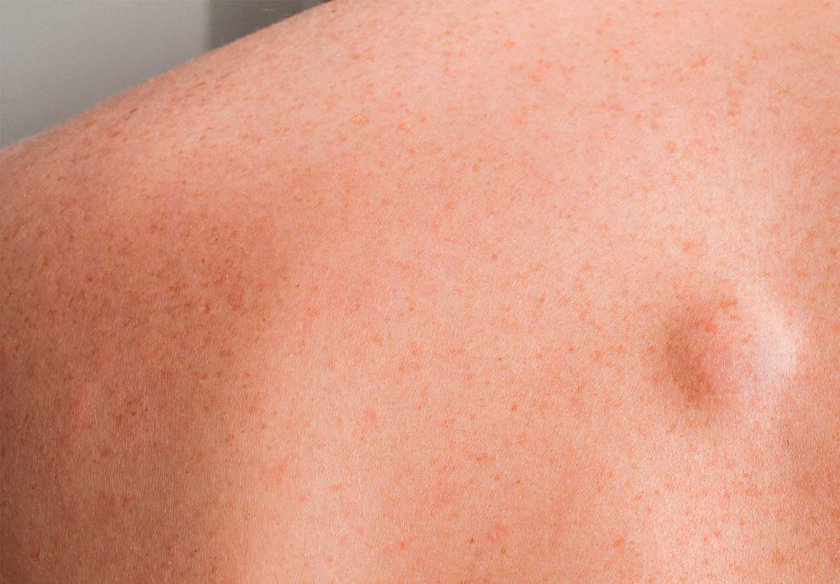 Lipomas en la piel: síntomas y causas según la medicina Lipomas en la piel: síntomas y causas según la medicina