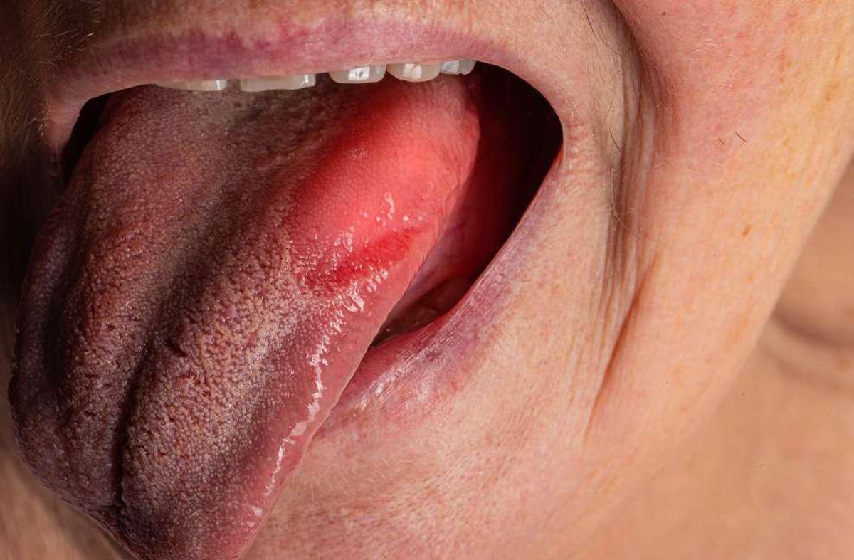 Lengua ardiente y con ampollas. Lengua ardiente y con ampollas.