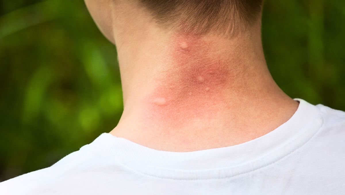 El uso de repelentes y la ropa larga pueden no ser suficientes para evitar las picaduras de mosquitos