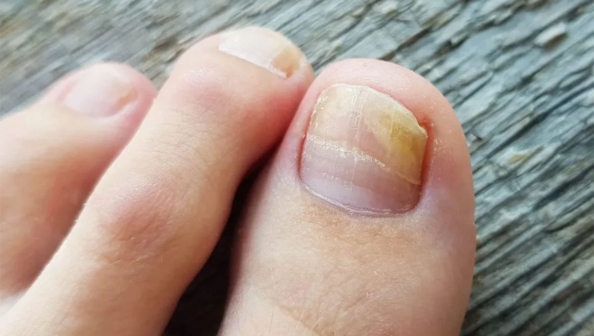 Cómo utilizar el bicarbonato para quitar los hongos de las uñas