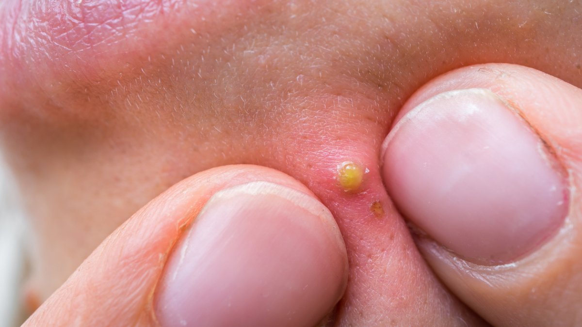 Para apretar tu grano debes hacerlo con cuidado. Este truco te ayudará a no dejar marcas en tu piel. Para apretar tu grano debes hacerlo con cuidado. Este truco te ayudará a no dejar marcas en tu piel.