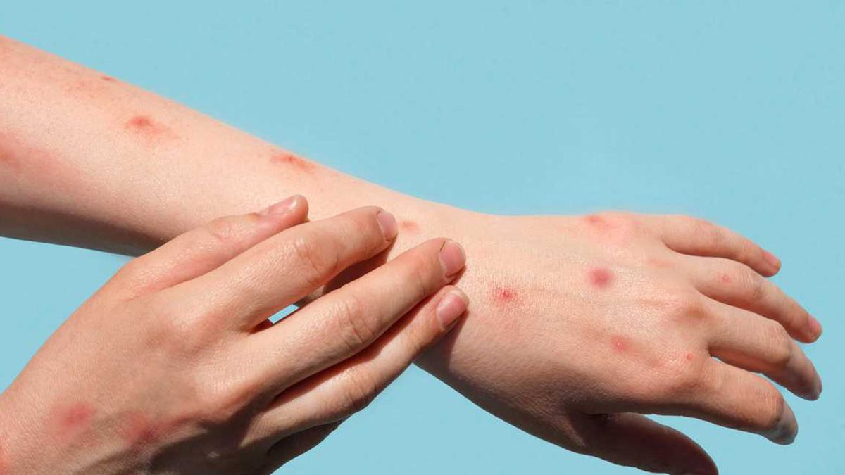 En 2022 hubo 15 casos confirmados de viruela de mono. En 2022 hubo 15 casos confirmados de viruela de mono.