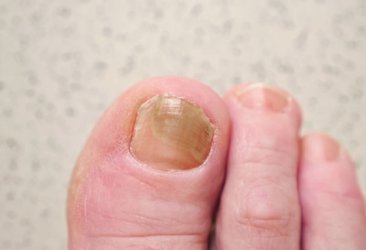 Los hongos en los pies pueden ser prevenidos con un elemento casero. Los hongos en los pies pueden ser prevenidos con un elemento casero.