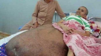 A un vietnamita le extirparon un tumor de 90 kilos que tenía en la pierna