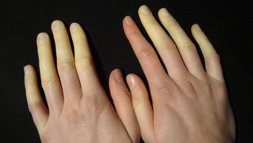 las manchas en las palmas de las manos