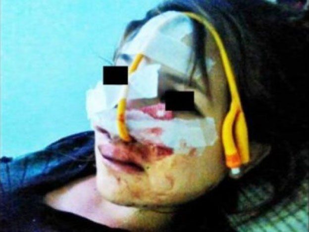 Una chica de 16 años embarazada fue desfigurada por su novio por abrir una cuenta de Facebook