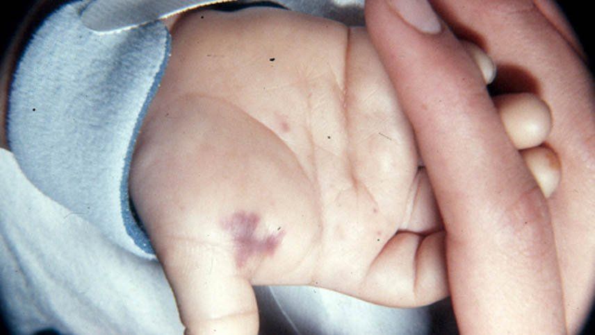 Qué es la meningococcemia, la enfermedad fulminante que mató a una mendocina en Chile