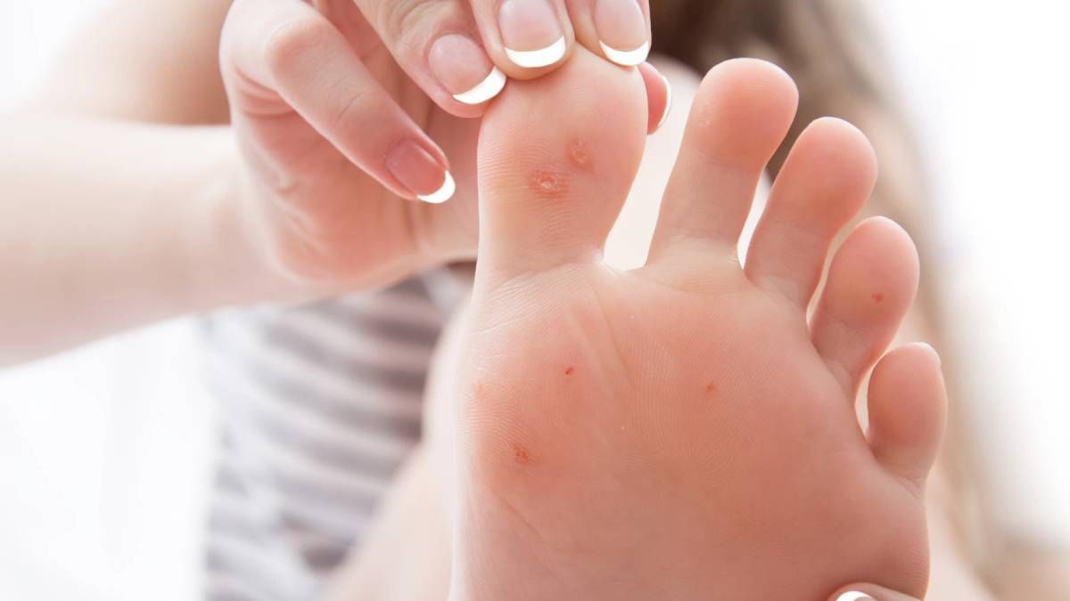 6 remedios naturales para eliminar los hongos de los pies.