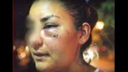 Un boxeador desfiguró a golpes a su ex pareja